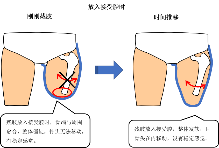 大腿假肢接受腔种类图片