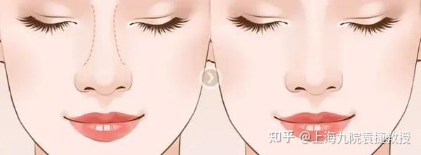 鼻梁不低但就是塌,你可能是伪塌鼻! - 知乎