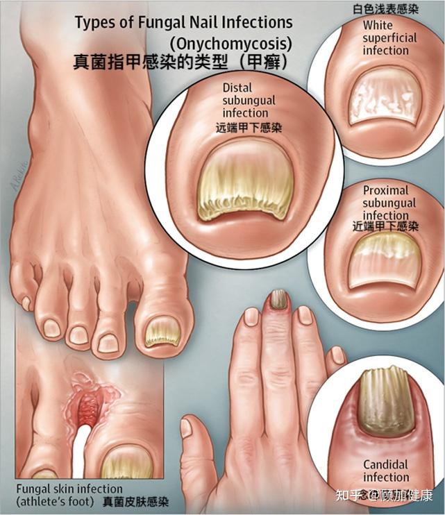 指甲上有白点缺钙缺锌