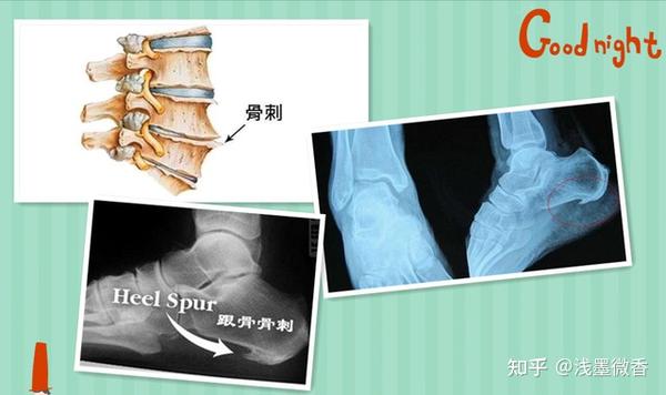 长骨刺究竟是补钙太多还是缺钙,很多人不知道 - 知乎