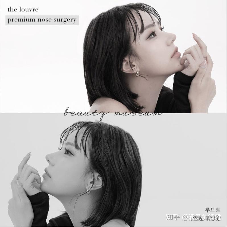 蒜头鼻(福鼻)怎么改善? - 知乎