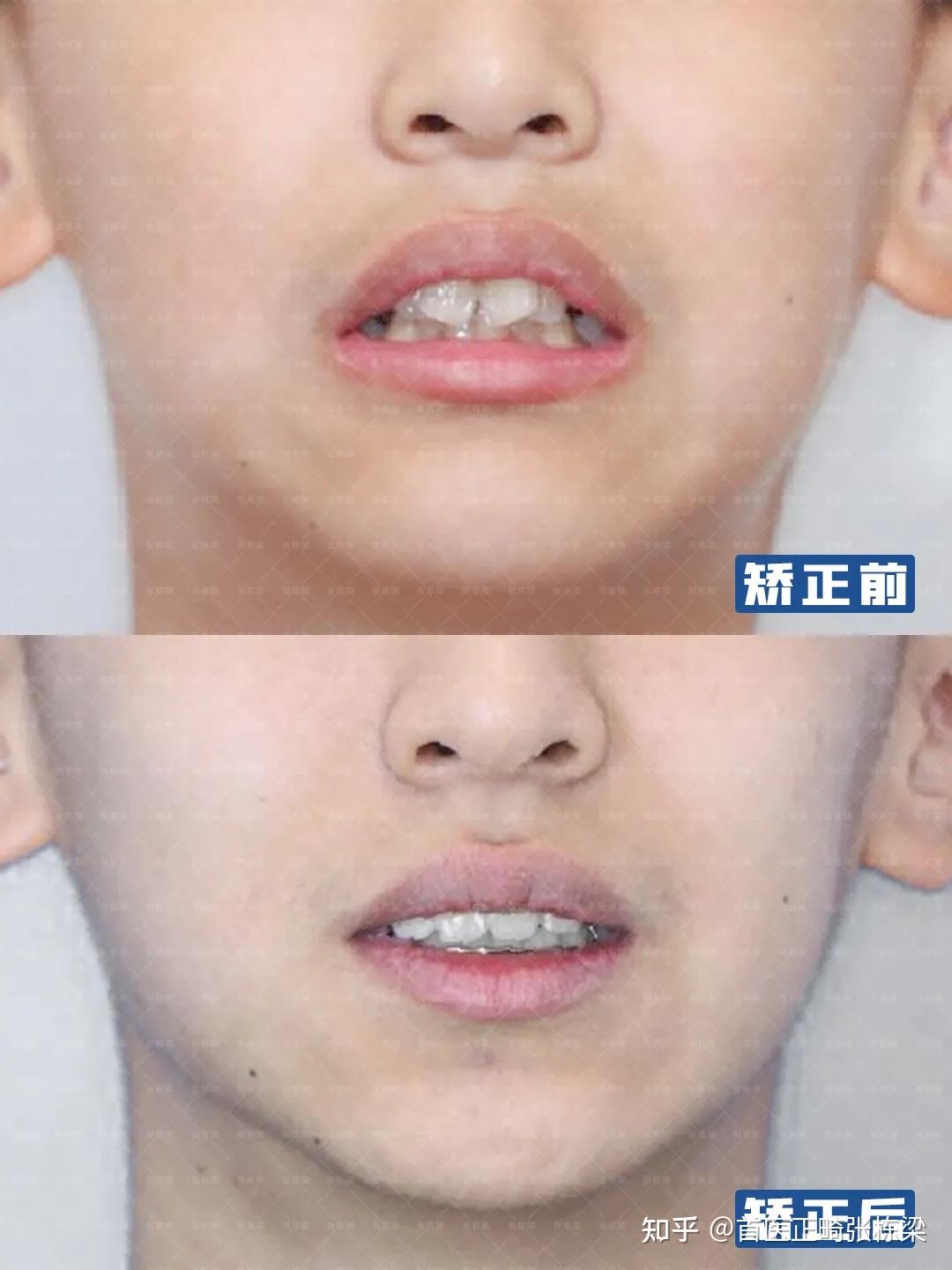 孩子门牙突外院都说要拔牙不拔牙矫正可以改善吗家长必看