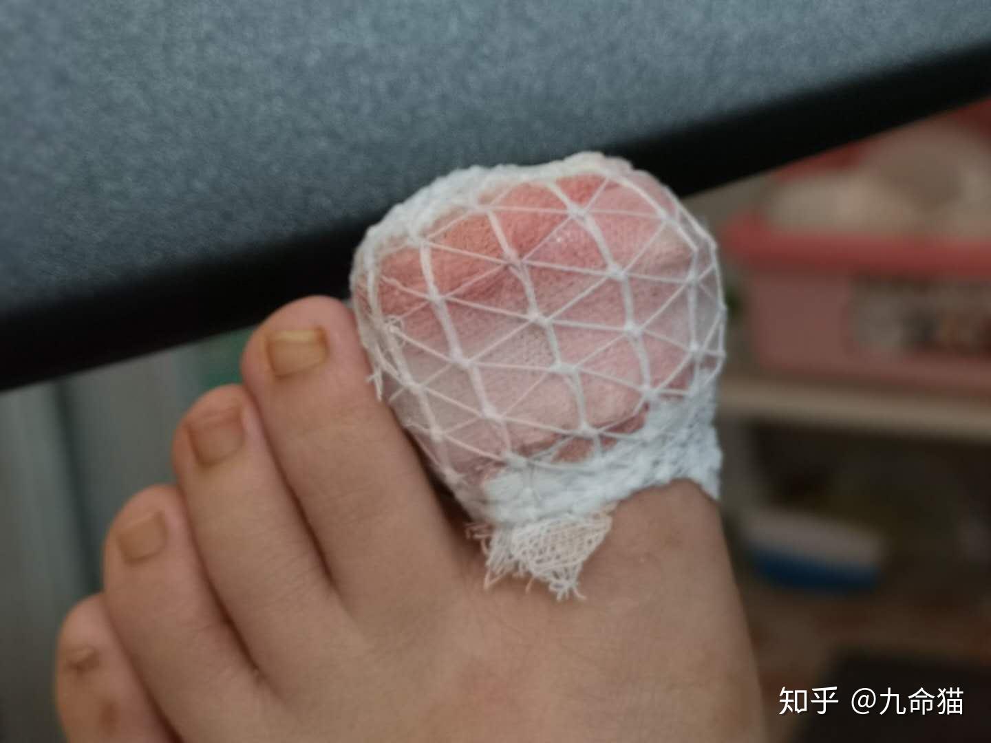 甲沟炎拔指甲是一种什么体验?术后如何护理?