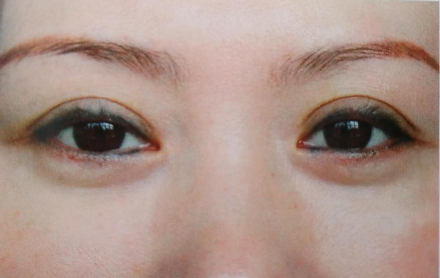 双眼皮三重睑如何修复 知乎