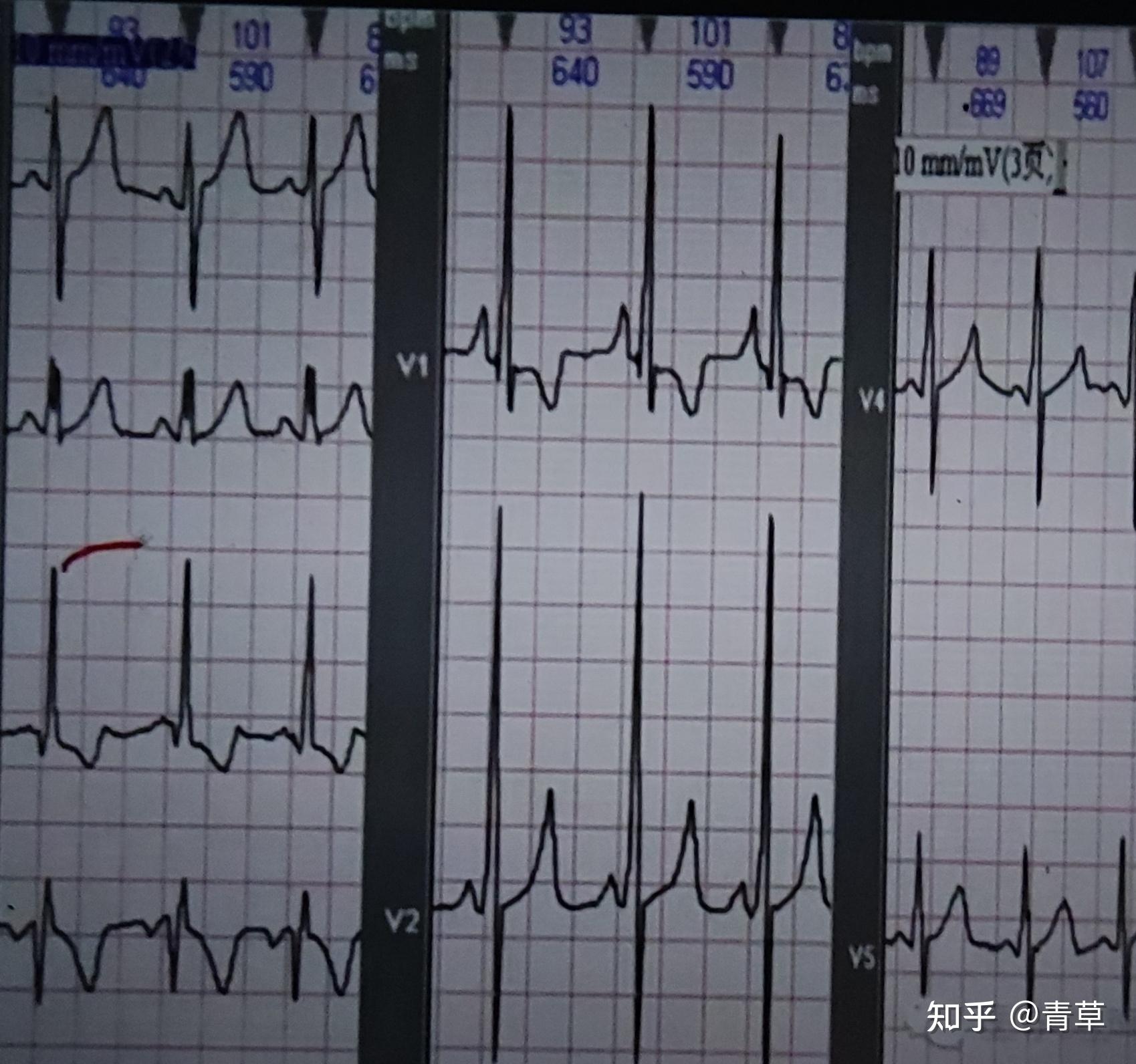 心电图qrs大于120图片