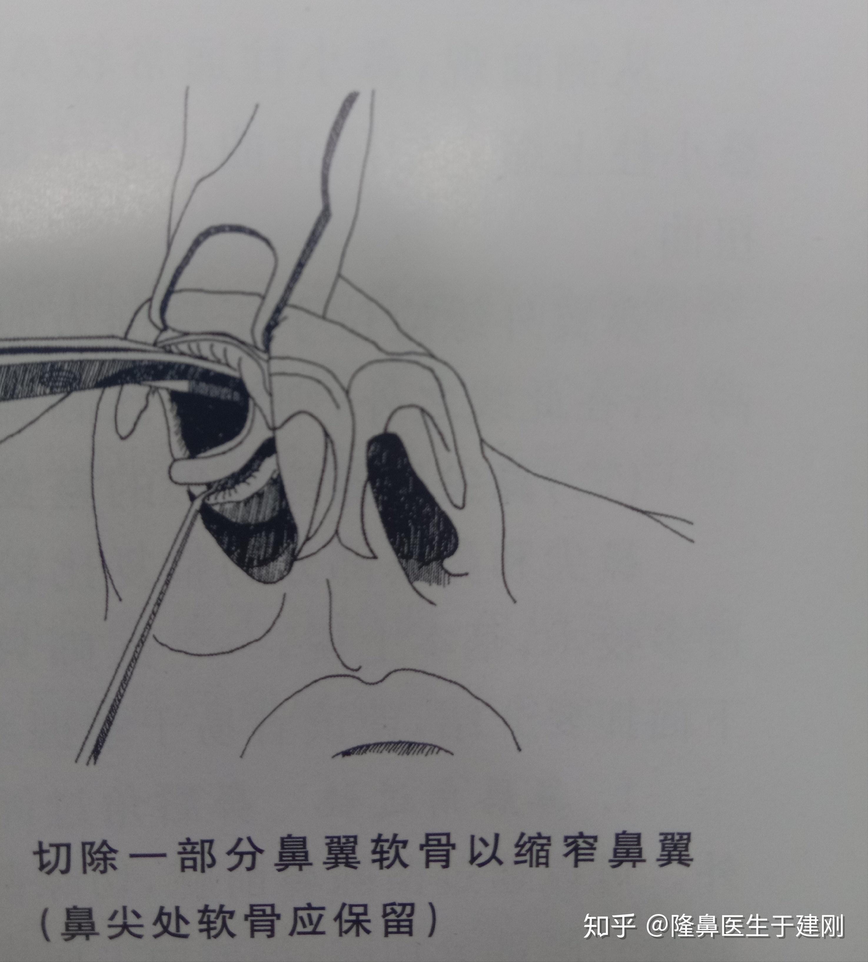 什么情况下可以做鼻骨截骨鼻骨截骨手术的操作步骤有哪些