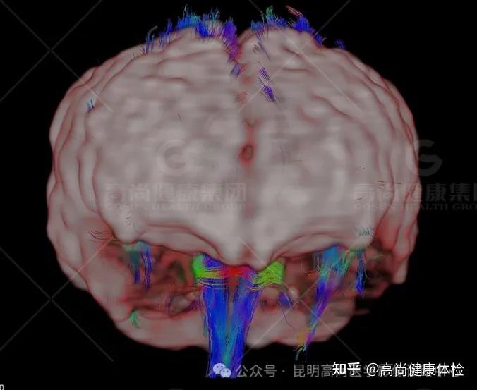 PET/CT-MR联合显像寻找致痫灶一例 - 知乎