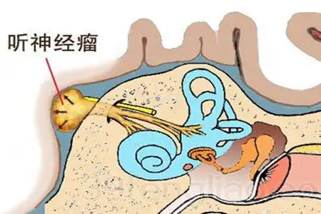 【就诊指南】听神经瘤有哪些主要评估指征？ - 知乎