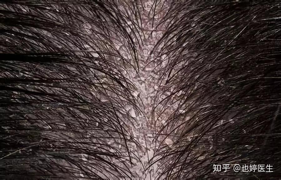 头皮脂溢性皮炎,你重视了吗? - 知乎
