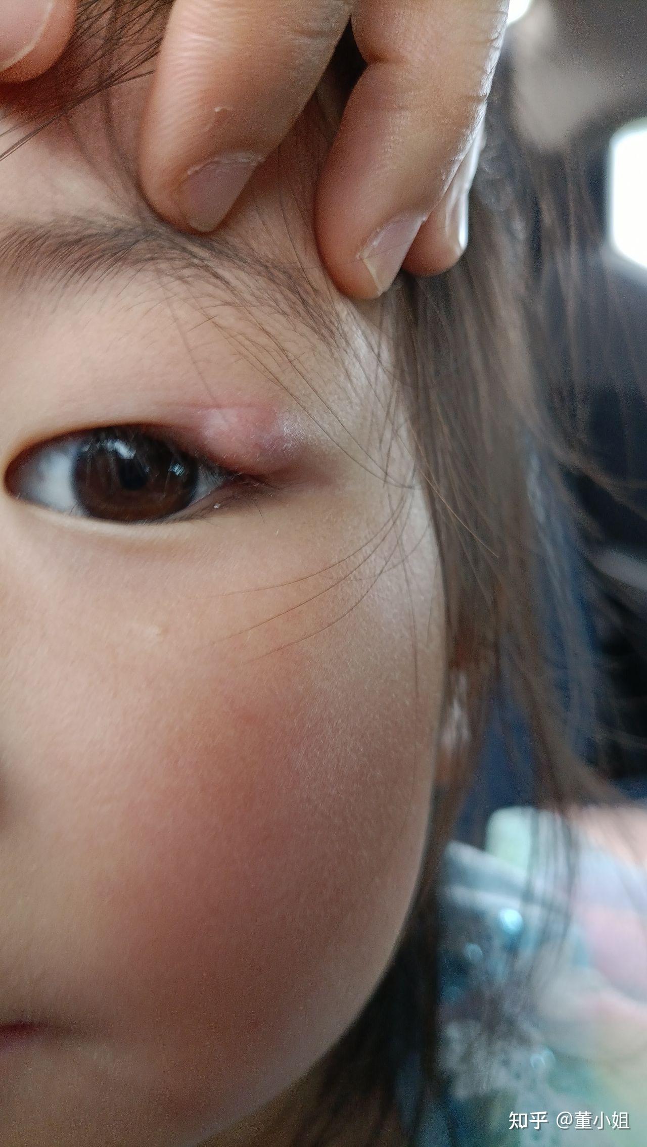 麦粒肿消散记 - 知乎