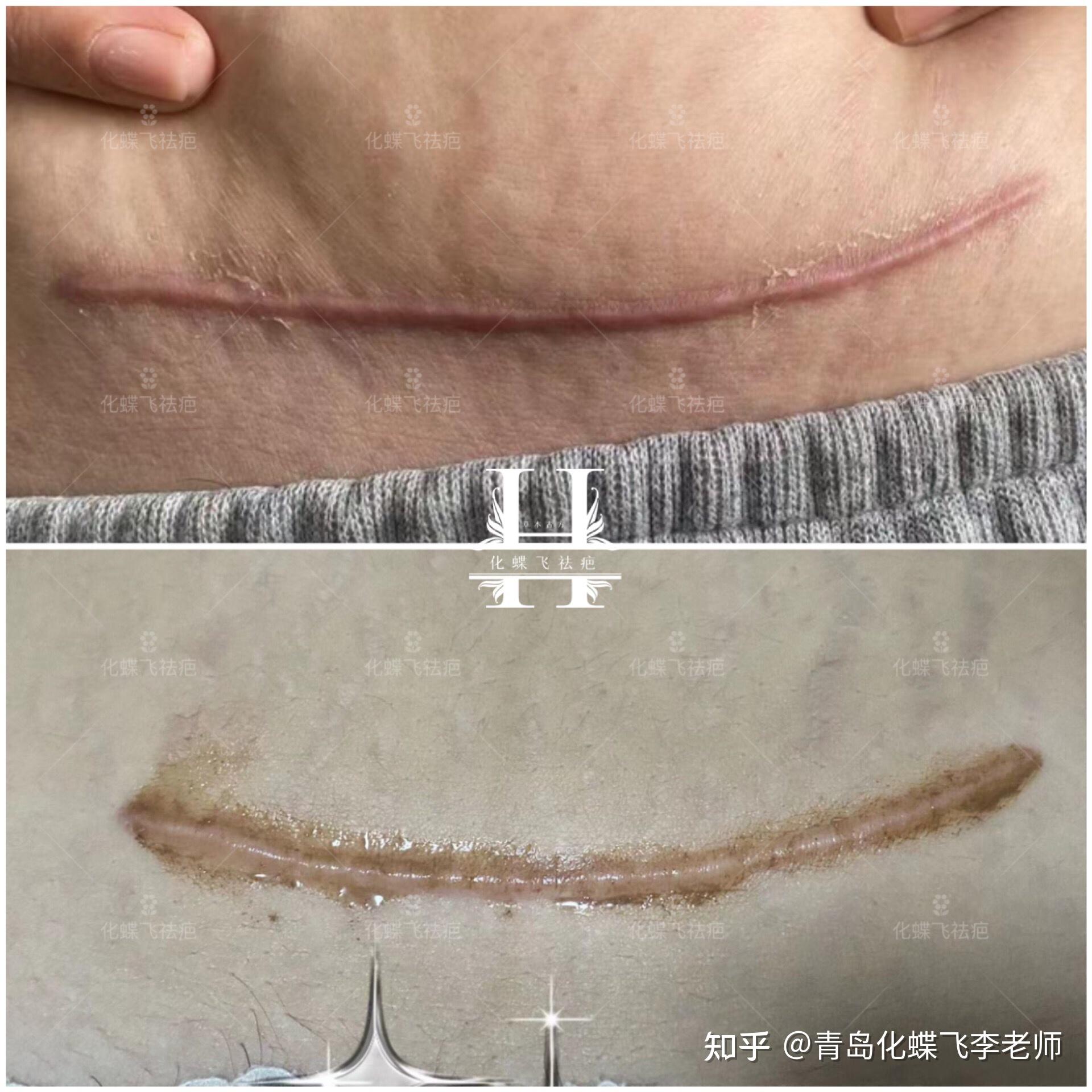 石家莊美女寶媽的剖腹產疤痕