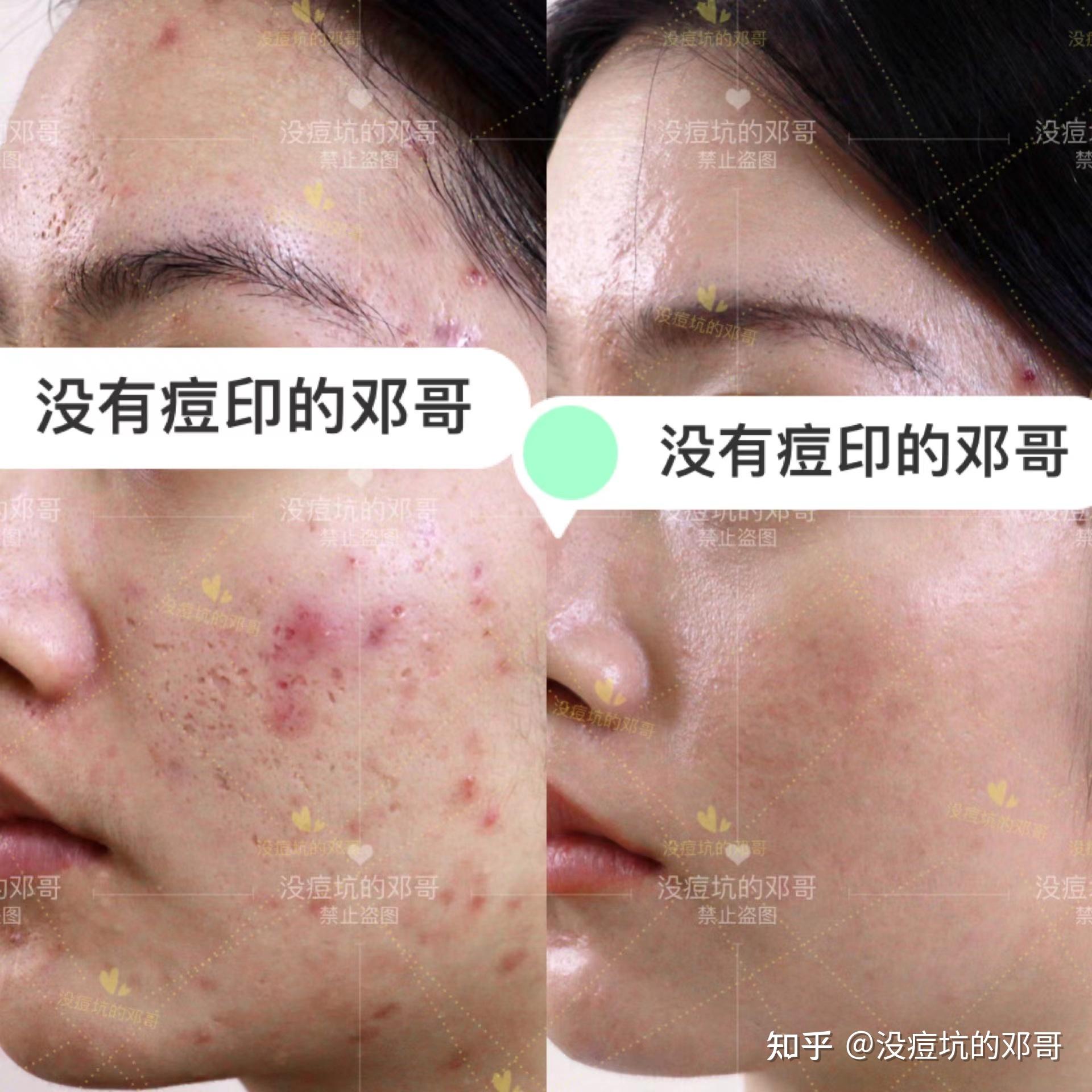 避坑指南痘坑修复中的各种坑