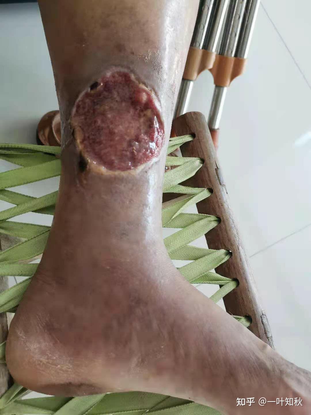 糖尿病后面的并发症离我们有多远