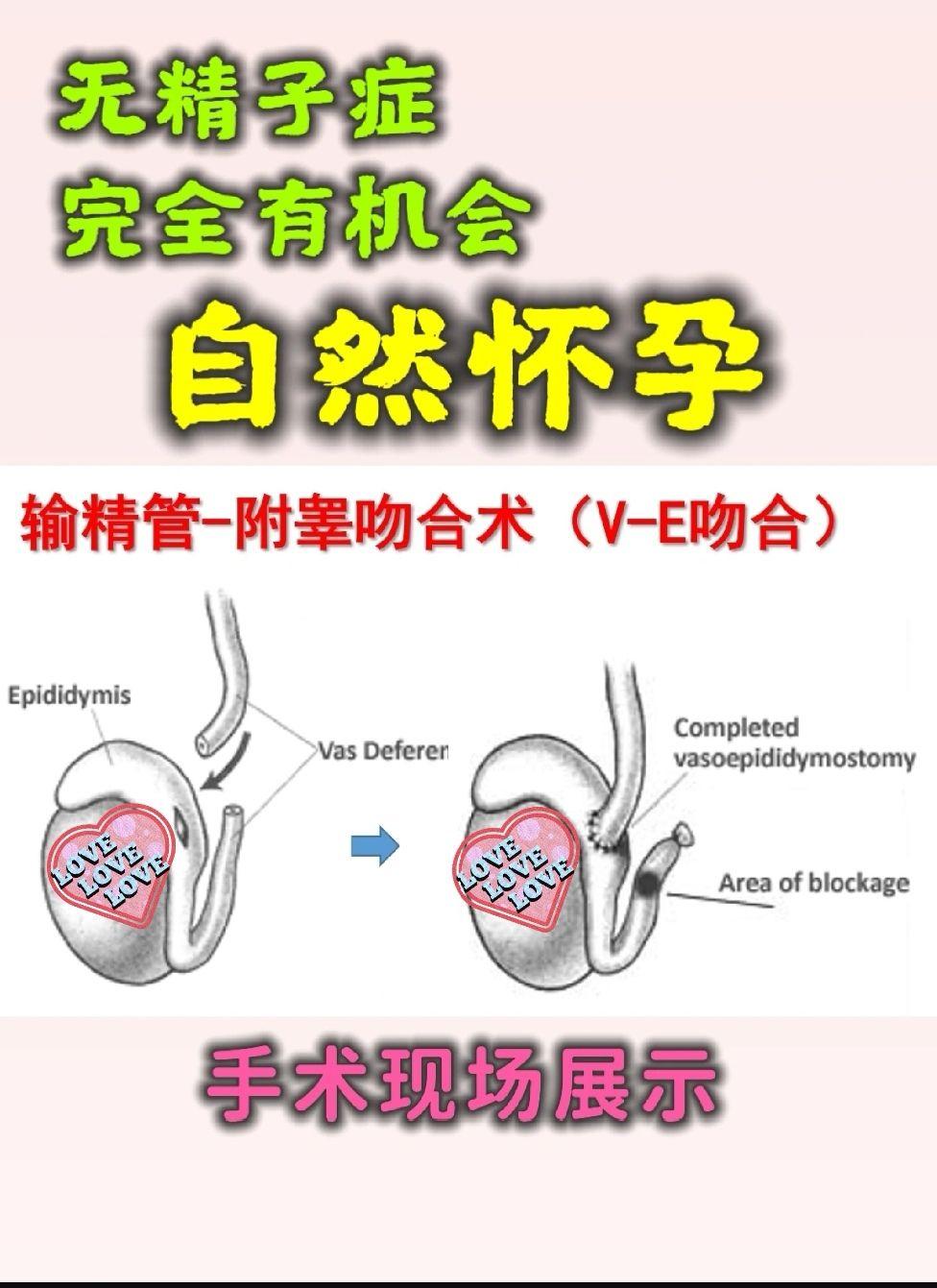 性无精子症)——幼年斜疝术后损伤精道探查 显微外科 输精管吻合术 术