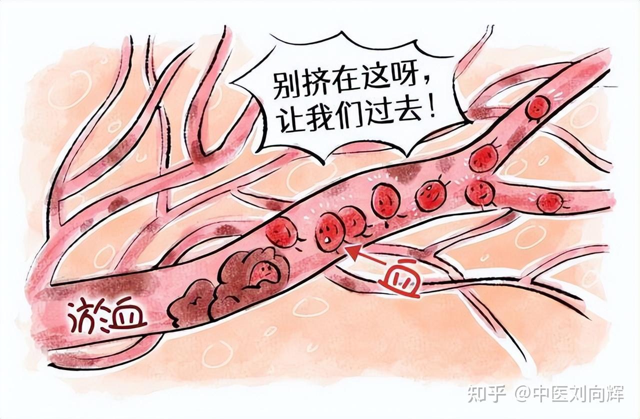 瘀血不通全身病,送你三个中药方,瘀血一通,全身轻松 - 知乎