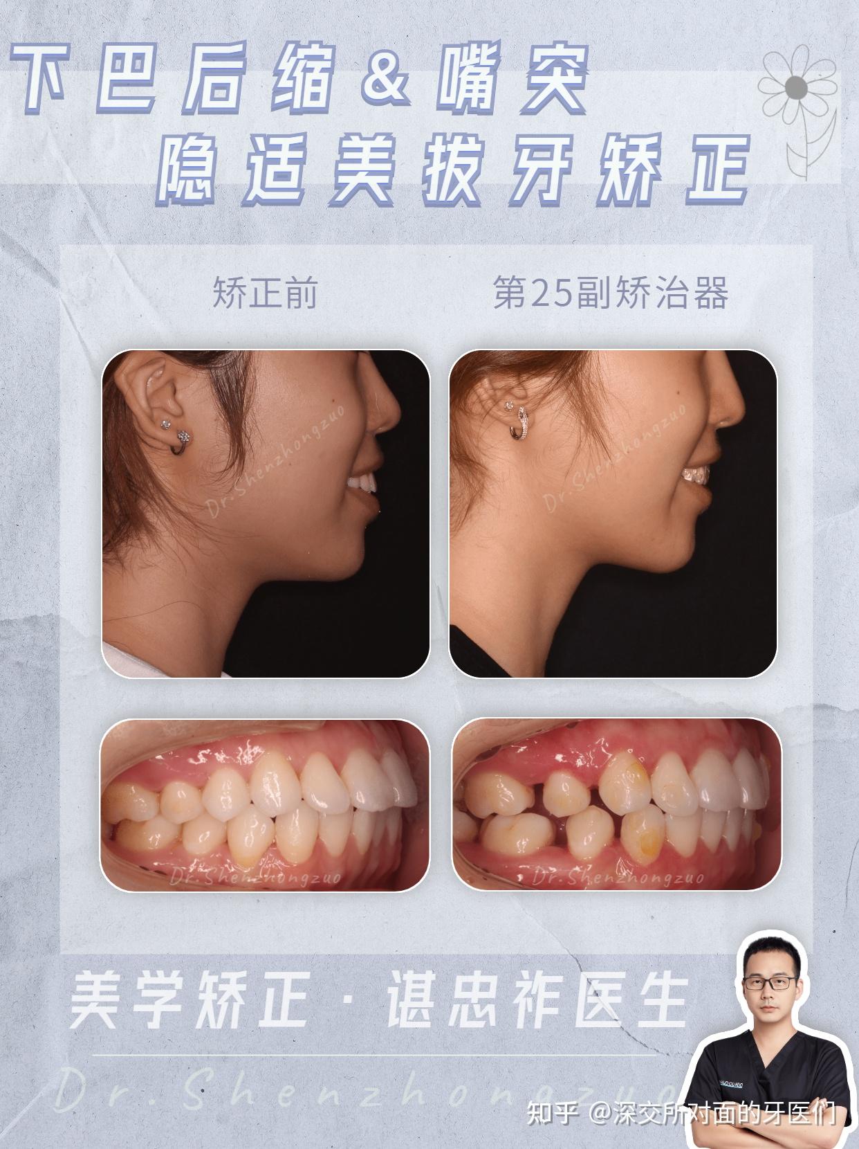牙齿整齐度超80的普通人为什么笑起来还是不好看04