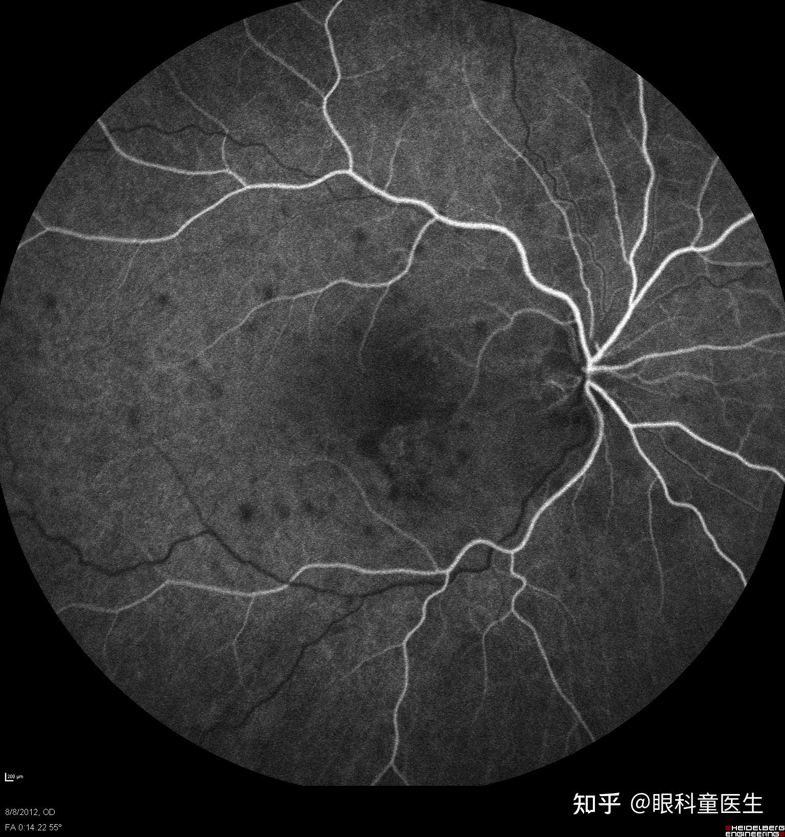 oct顯示病灶在視網膜色素上皮層和脈絡膜毛細血管層雙眼pic,眼底照片a