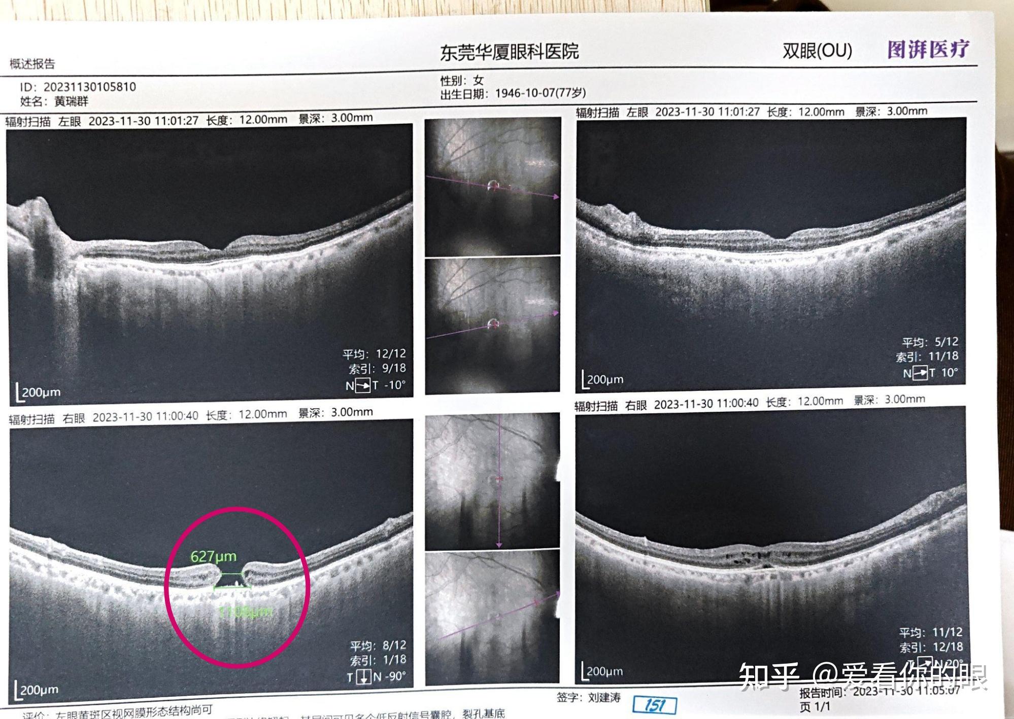 黄斑裂孔 同一患者双眼不同时期的巧遇与手术治疗的奇迹