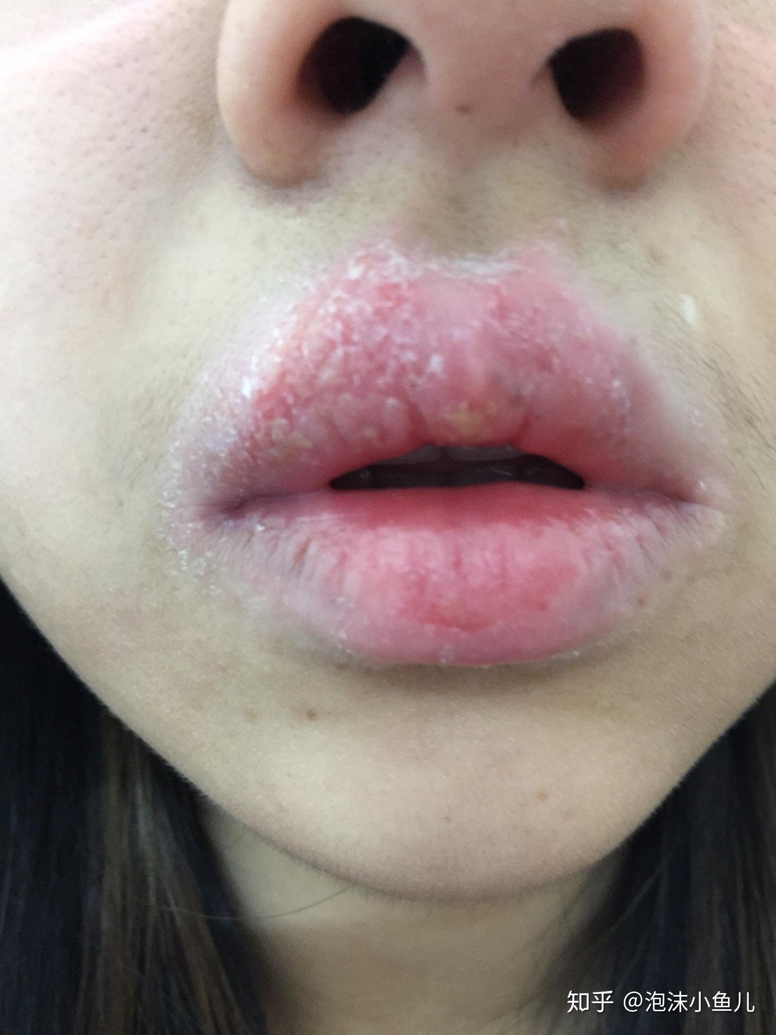 唇炎病案1例