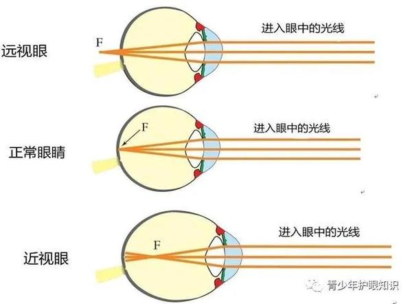 孩子的远视储备不足，还有多久就会近视？ - 知乎