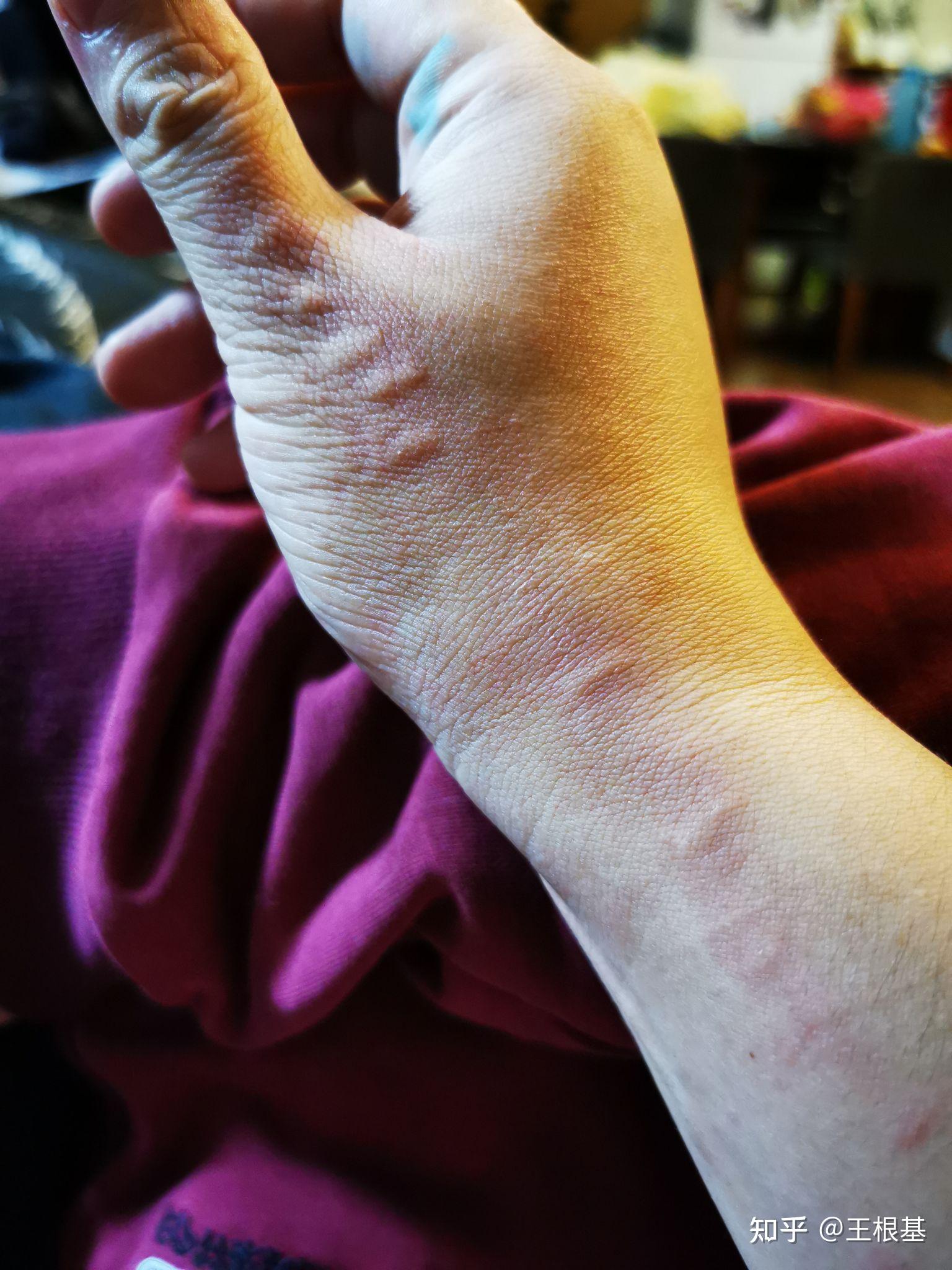 胳膊晚上突然起了一片疙瘩