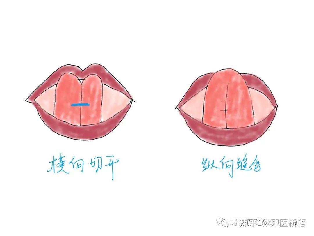 Surgery - Tongue Tie