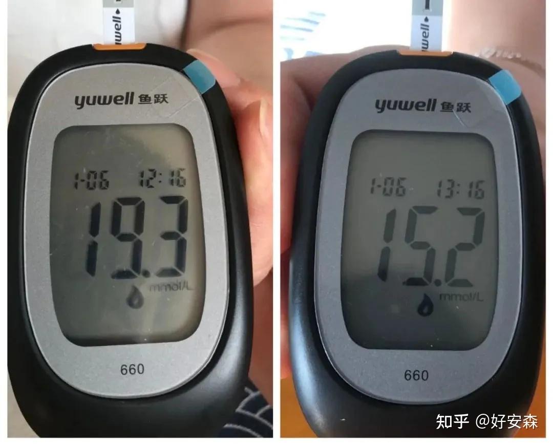 刘女士体验12天,血糖值19.3→11.