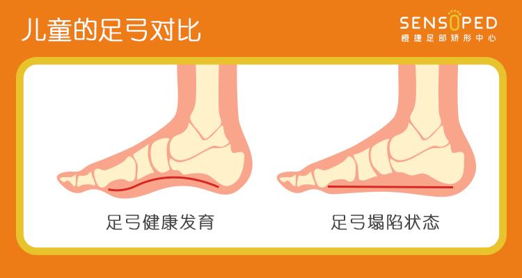 再到逐渐长大后的跑跳,踏出的每一步都至关重要,而足弓的发育,形态