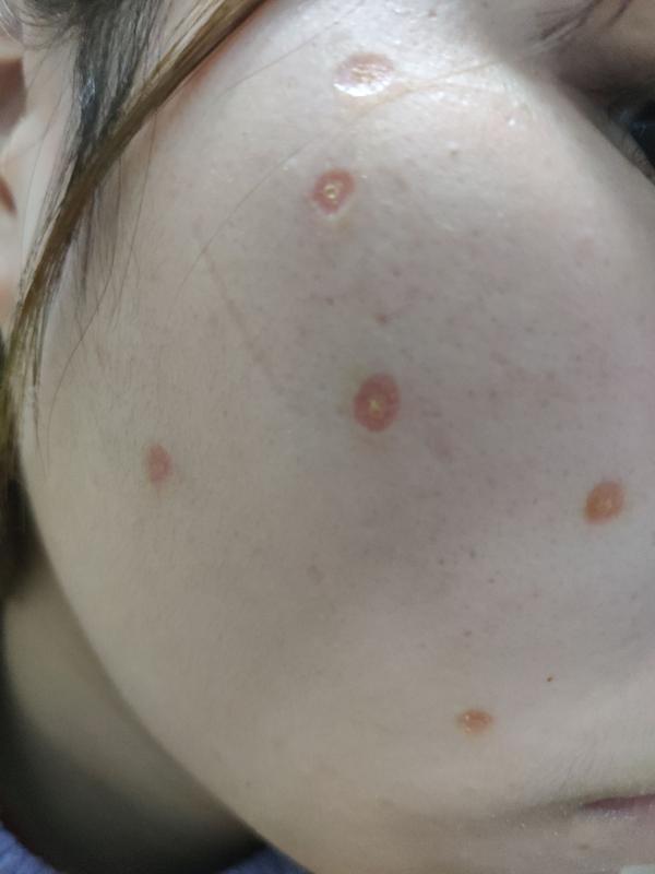 我的激光祛痣记录