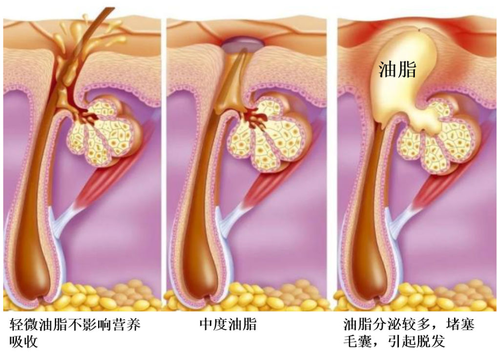 第1步:疏通毛囊