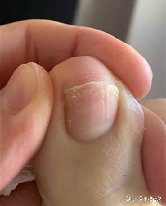 灰指甲前期长什么样子还有希望治好吗