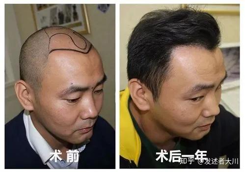 植发前评估(植发前后效果)