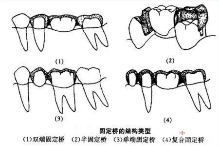 固定义齿可恢复缺失牙的解剖形态和生理功能,较大程度地恢复口腔功能