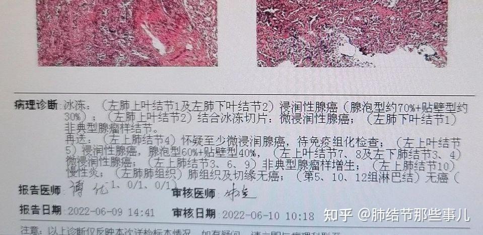 戴主任的患者感觉最好能把有危险的磨玻璃结节一网打尽.