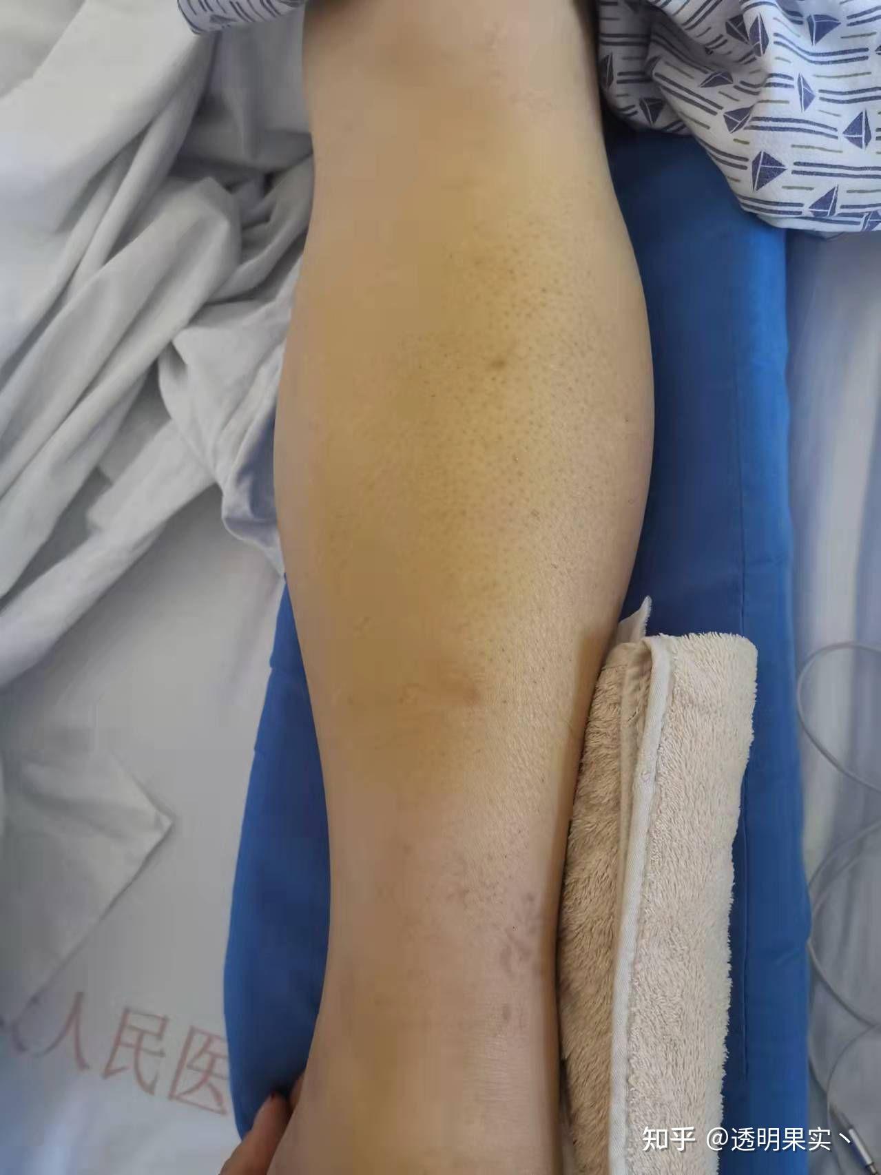 记录一下小腿胫腓骨骨折