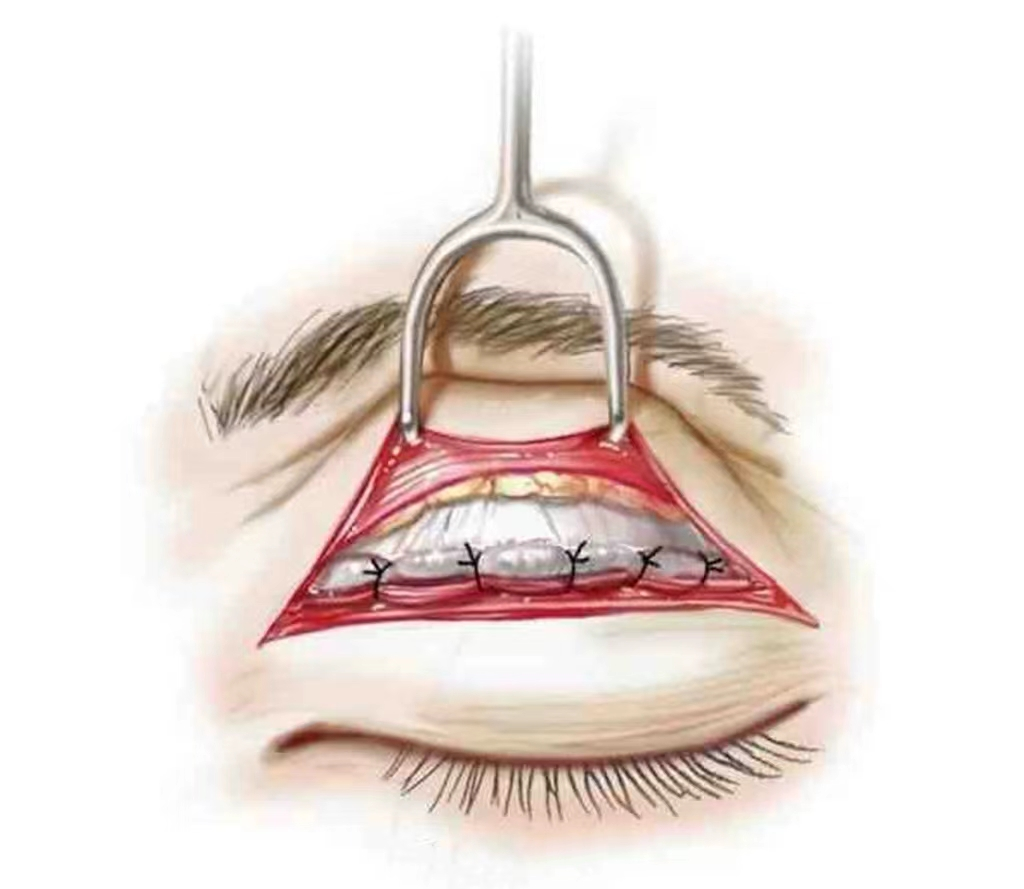 眼部（上睑）组织解剖及重睑术（双眼皮）注意事项 整形专家---祝海新 - 知乎