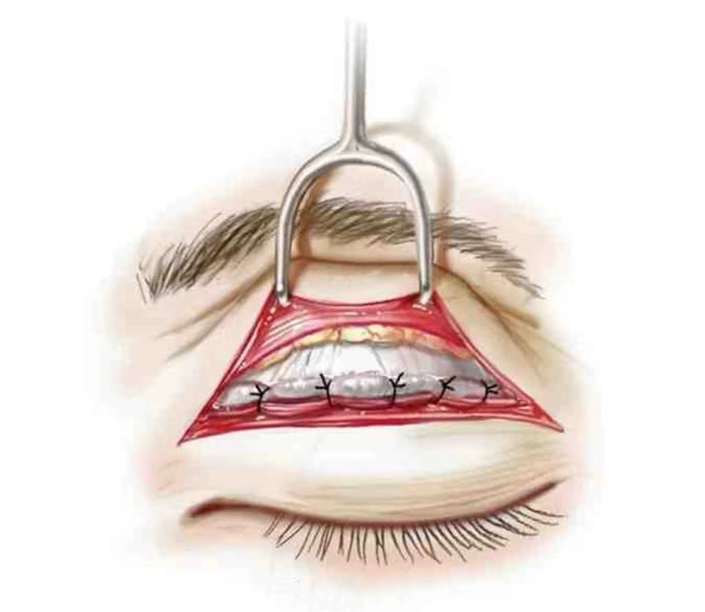 简单介绍下park法重睑术—双眼皮推荐术式