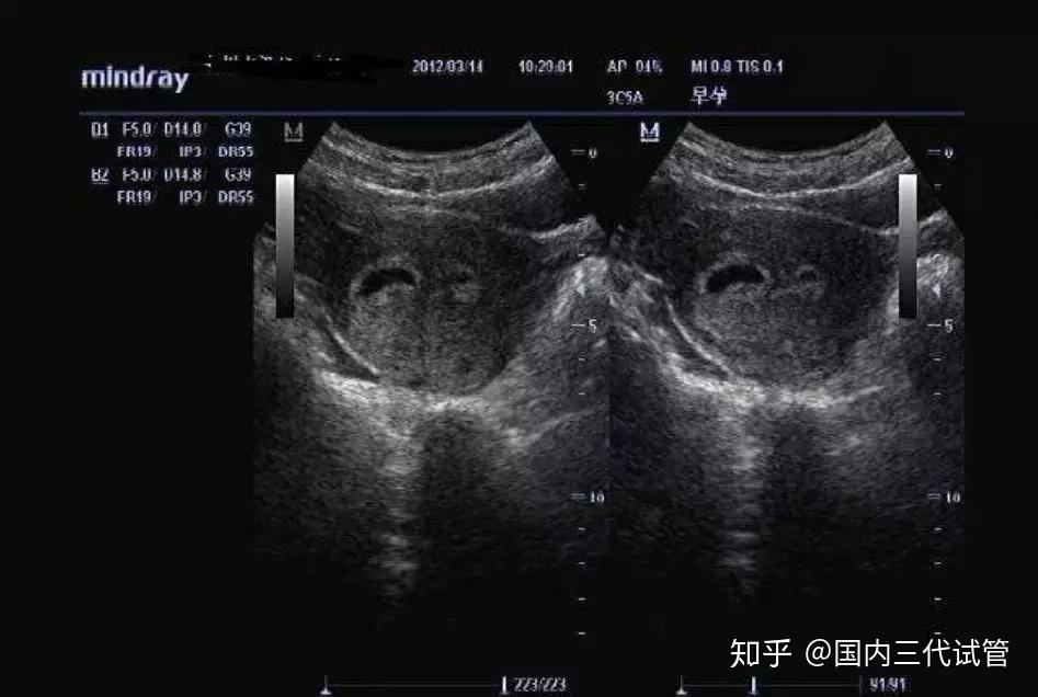 宫腔粘连您了解吗进来瞧瞧