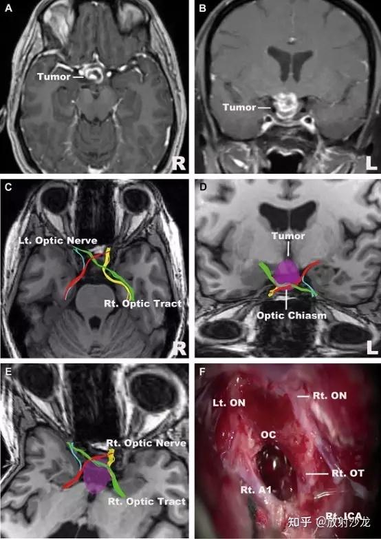 視束;d,e,高分辨率示蹤提示視神經和腫瘤關係密切;d,冠狀位前面觀;e