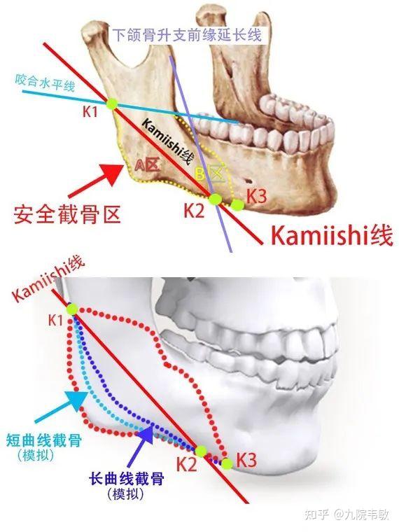 这是为了避开下颌骨部位非常重要的颏神经