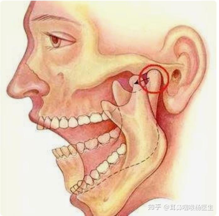 下颌骨错位图片