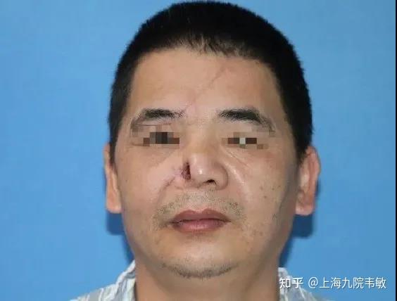 通过这个方式整形如何成功修复鼻翼缺损