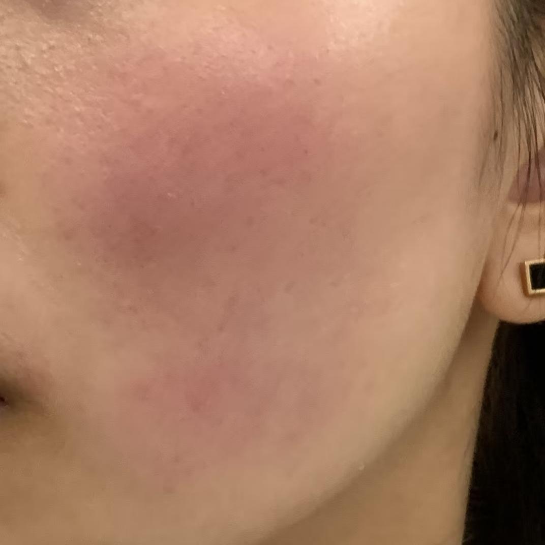 皮肤屏障受损脸上泛红怎么快速修复