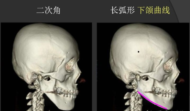 1997 年gui等提出"一次性下颌角弧形截骨术,后面部分医生又开始开展