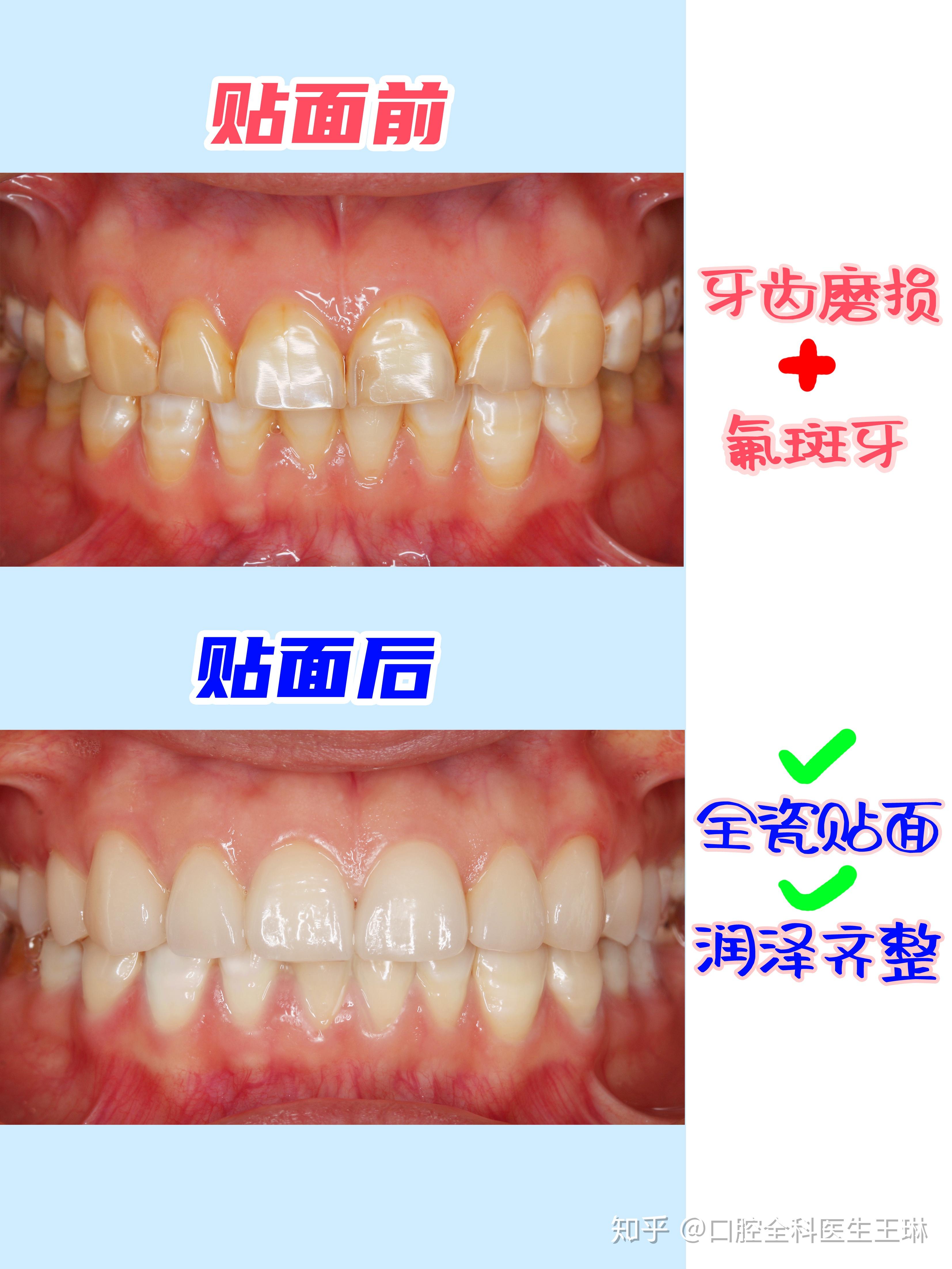 牙齿贴面修复让笑容不再遮遮掩掩