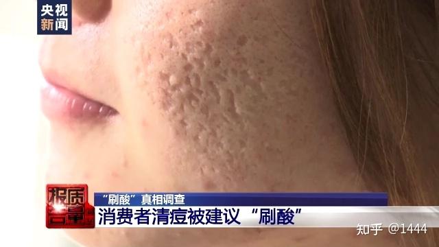 正确认识刷酸以及不正确刷酸对皮肤的影响