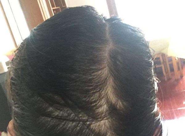 油脂溢性脱发怎么治疗头发油腻脱发怎么办