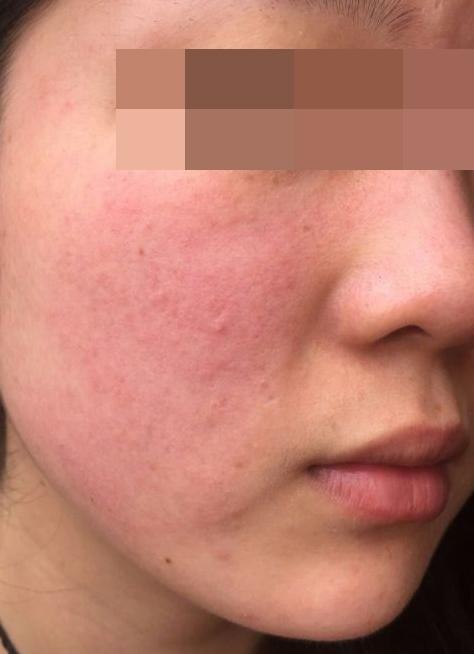 分享我的敏感皮肤红血丝修复经历