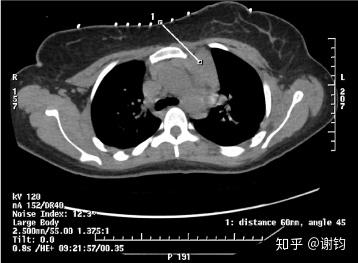 现代医学成像(3)——CT(基本原理与图像重建) - 知乎