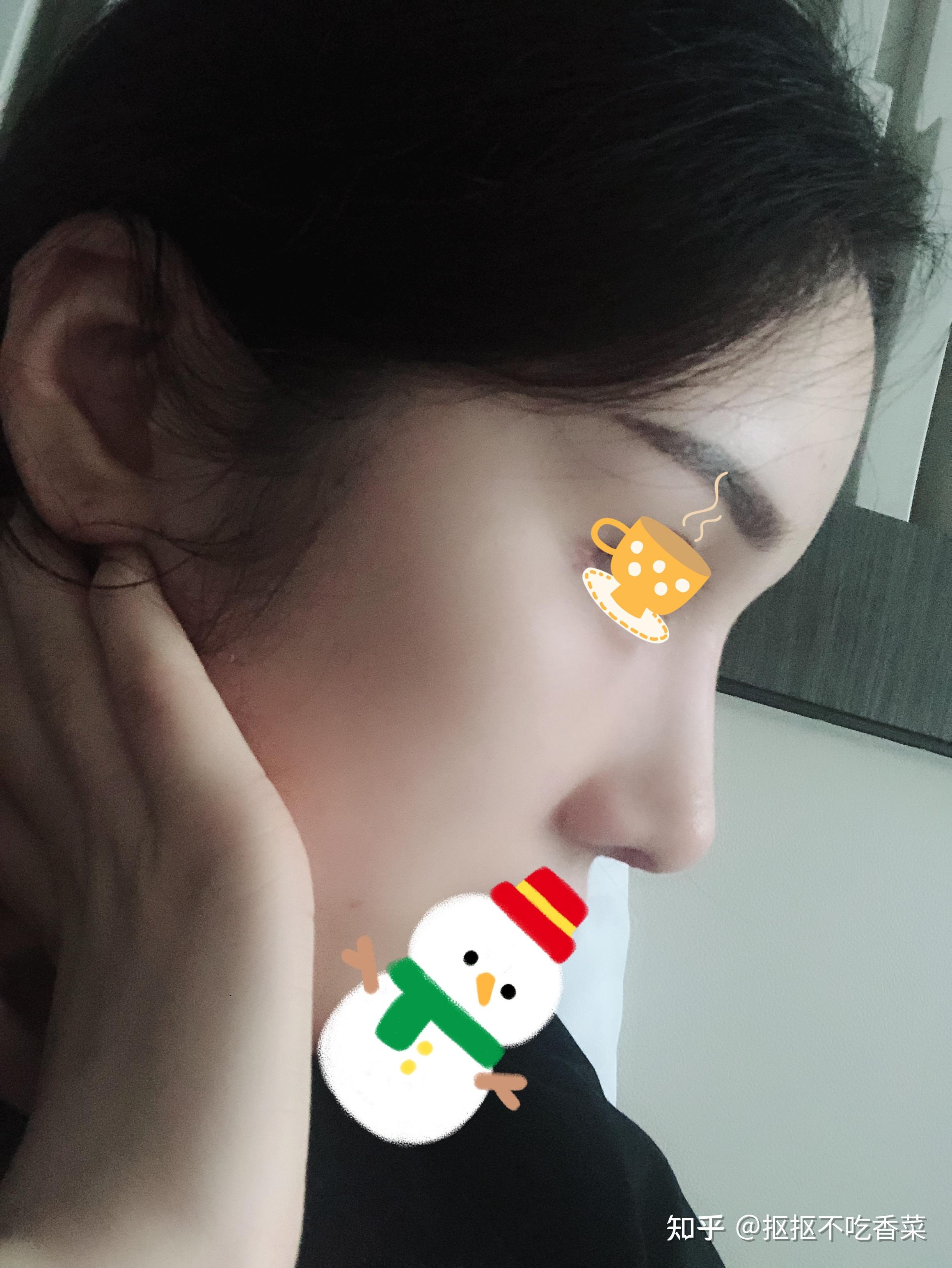 年前找王英勇做的肋骨鼻修复到现在二十多天了